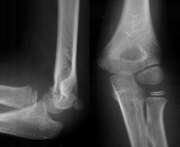 Joint Replacement Plano