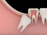 Treatment for Exposed Nerve in Tooth